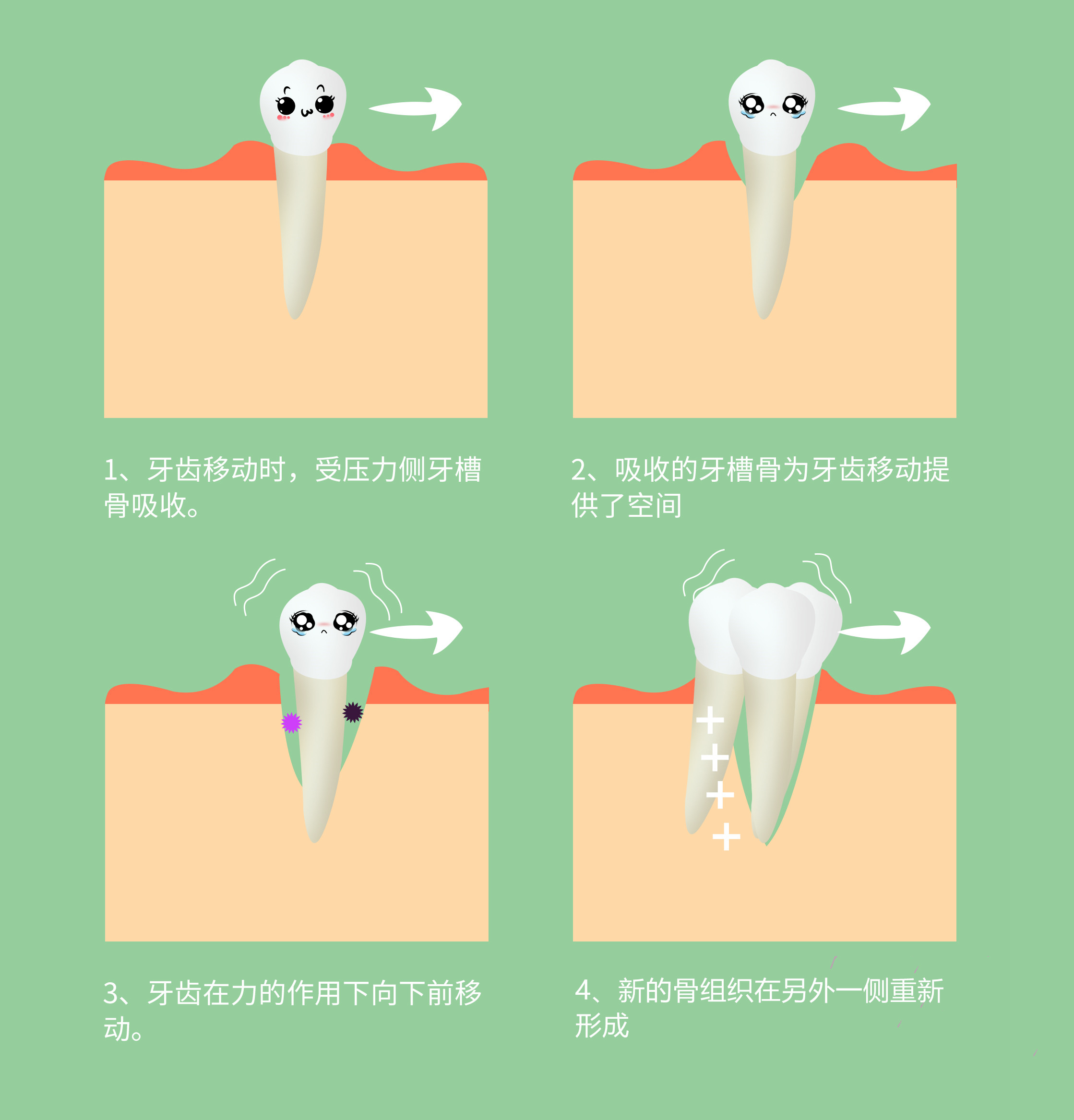 牙齿矫正历程