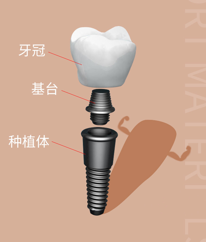 一颗莳植牙的组成